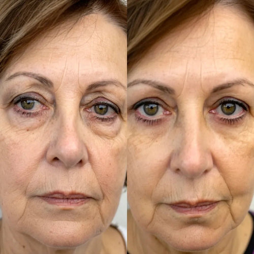 Lumavie™ Lentes de Rehabilitación de Ojeras