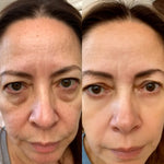 Antes y después: la sombra bajo el ojo se aclara