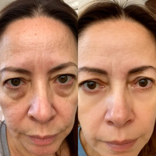 Lumavie™ Lentes de Rehabilitación de Ojeras
