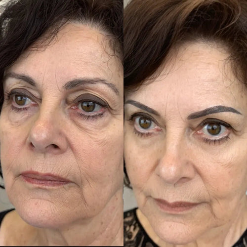 Lumavie™ Lentes de Rehabilitación de Ojeras