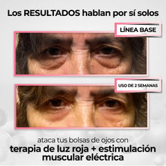 Lumavie™ Lentes de Rehabilitación de Ojeras